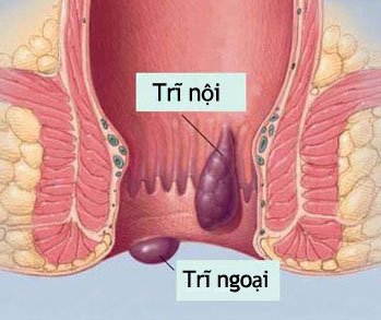 Học cách phòng ngừa bệnh trĩ hiệu quả