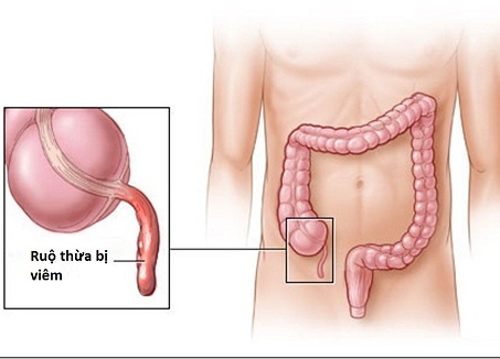 Kết quả hình ảnh cho biểu hiện đau ruột thừa