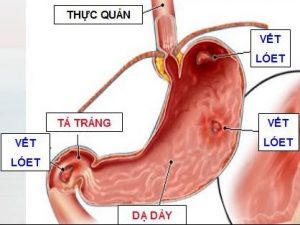 cach-chua-day-hoi-chuong-bung-hieu-qua-benhduongtieuhoa