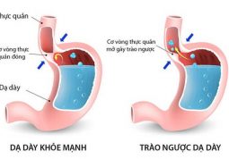 Triệu chứng trào ngược dạ dày thực quản