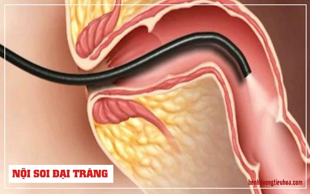 nội soi đại tràng đau không