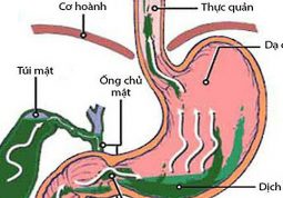 Tìm hiểu bệnh trào ngược dịch mật