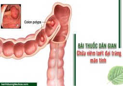 cách chữa viêm loét đại tràng mãn tính bằng các bài thuốc dan gian