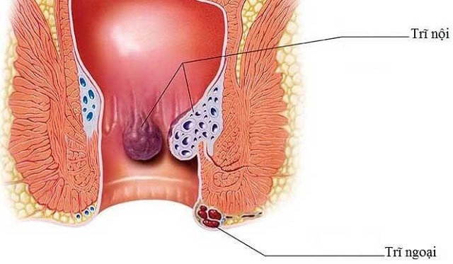 Dấu hiệu bệnh trĩ