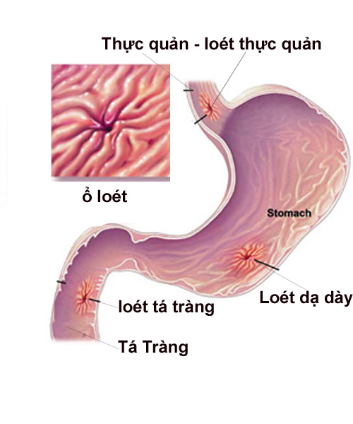 benh-an-thung-o-loet-da-day-ta-trang