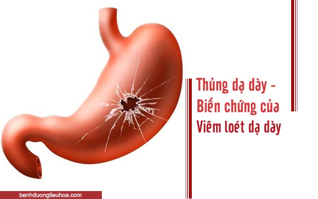 biến chứng của viêm loét dạ dày là thủng dạ dày