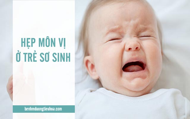 những điều cần biết về hẹp môn vị ở trẻ sơ sinh