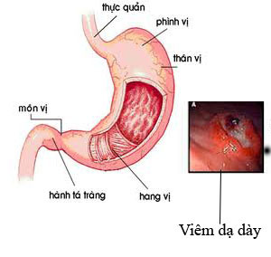 lam-gi-khi-bi-viem-hang-vi-da-day-phu-ne-xung-huyet