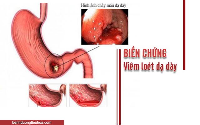 xuất huyết dạ dày là biến chứng của viêm loét dạ dày