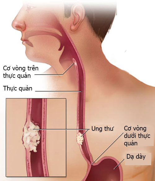 dau-hieu-nhan-biet-benh-ung-thu-thuc-quan