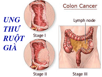 nhung-bieu-hien-cua-benh-ung-thu-ruot-gia