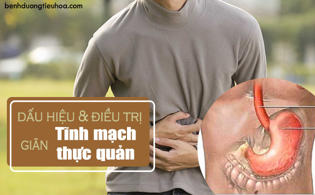 giãn tĩnh mạch thực quản và những điều cần biết