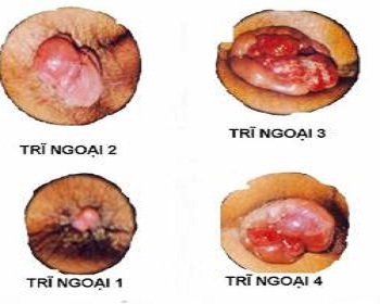 Các giai đoạn của bệnh trĩ ngoại bạn cần biết