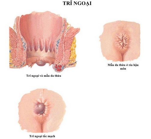 Hình ảnh liên quan đến bệnh trĩ ngoại