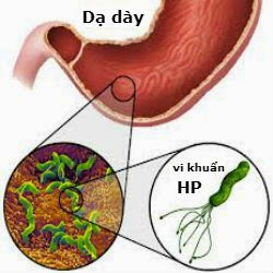 cach-dieu-tri-vi-khuan-hp-trong-da-day-hieu-qua-nhat-3