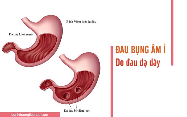 đau bụng âm ỉ có thể là bệnh đau dạ dày