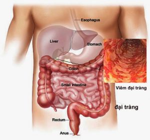 Bệnh viêm đại tràng co thắt là gì?