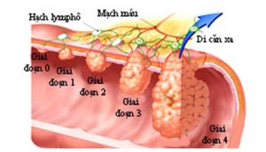 Viêm đại tràng co thắt gây ung thư đại tràng