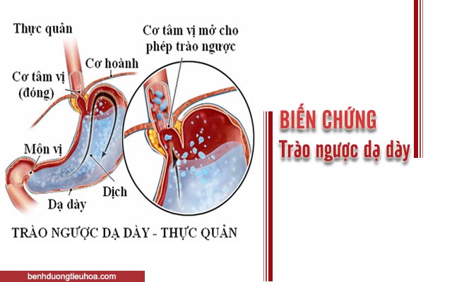 biến chứng của trào ngược dạ dày thực quản