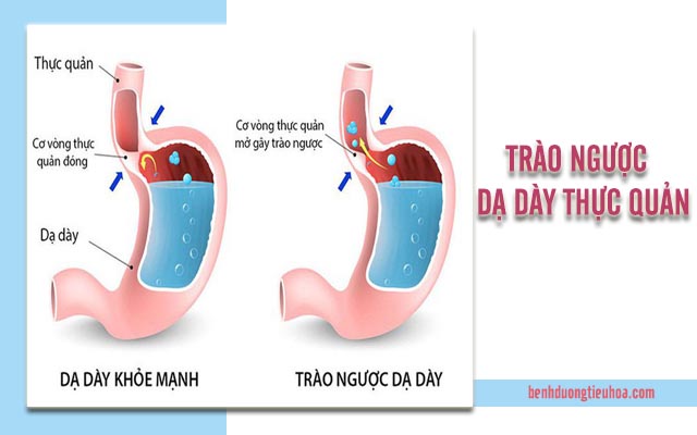 bị chít hẹp thực quản dẫn đến biến chứng nguy hiểm