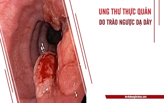 ung thư thực quản là biến chứng của trào ngược dạ dày