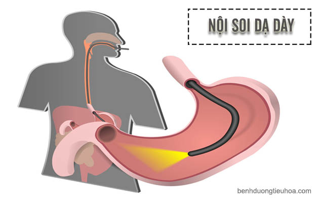 đau bụng sau khi nội soi dạ dày