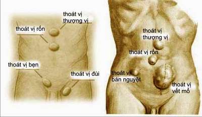 thong-tin-ve-chung-thoat-vi-thanh-bung5