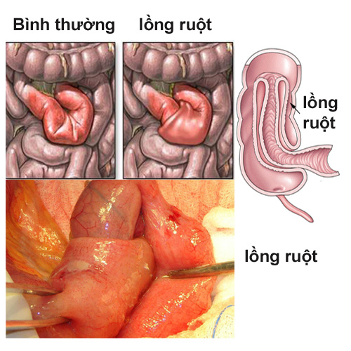 tim-hieu-su-nguy-hiem-cua-benh-long-ruot1