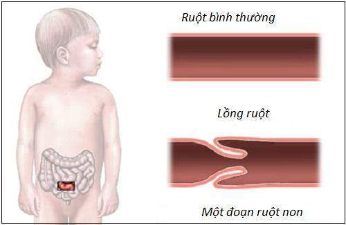 benh-long-ruot-o-tre-em-dau-hieu-nhan-biet-va-cach-dieu-tri1