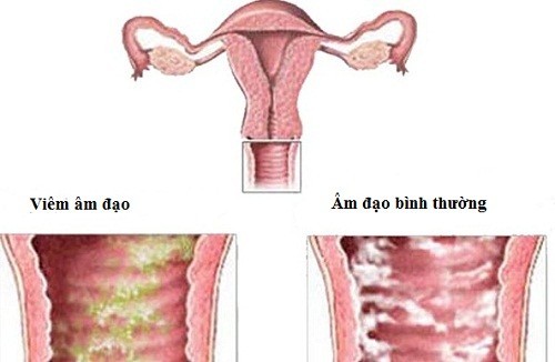 dau-bung-duoi-kem-dau-lung-la-dau-hieu-cua-benh-gi3