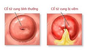 dau-bung-duoi-kem-dau-lung-la-dau-hieu-cua-benh-gi4