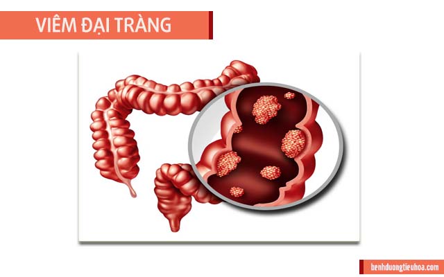 các chứng bệnh về đại tràng