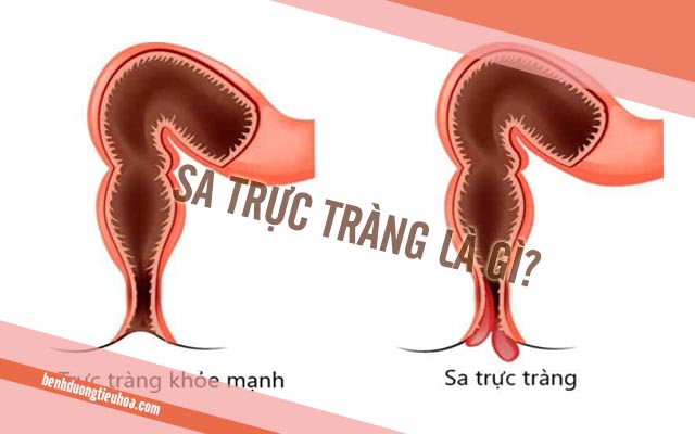 sa trực tràng là bệnh gì