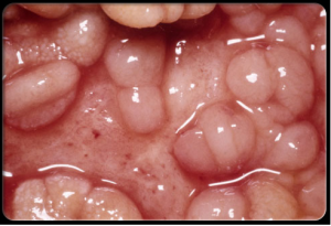 benh-Crohn-la-gi-nguyen-nhan-trieu-chung-va-cach-dieu-tri