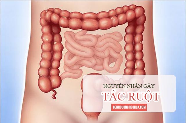 nguyên nhân gây tắc ruột