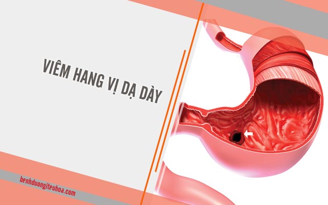 bệnh viêm hang vị dạ dày