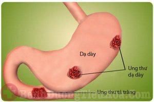  Ung thư dạ dày bắt buộc phải mổ