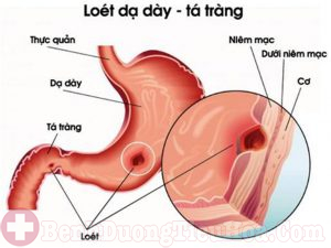 Viêm loét dạ dày tá tràng cần phải mổ