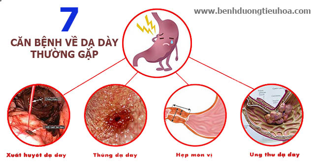 TOP 7 loại bệnh về dạ dày thường gặp nhất 