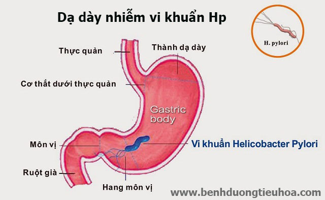 TOP 7 loại bệnh về dạ dày thường gặp nhất do vi khuẩn Hp