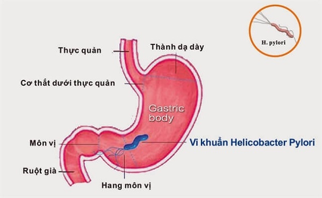 Vi khuẩn Helicobacter pylori gây bệnh dạ dày