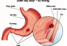 Triệu chứng viêm loét dạ dày