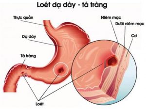 Triệu chứng viêm loét dạ dày