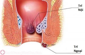 triệu chứng bệnh trĩ