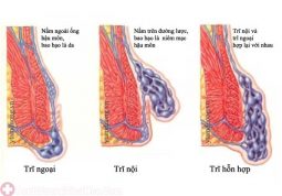 Bệnh trĩ là gì