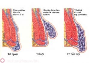Hình ảnh bệnh trĩ