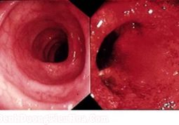 Hình ảnh nội soi viêm đại tràng xuất huyết