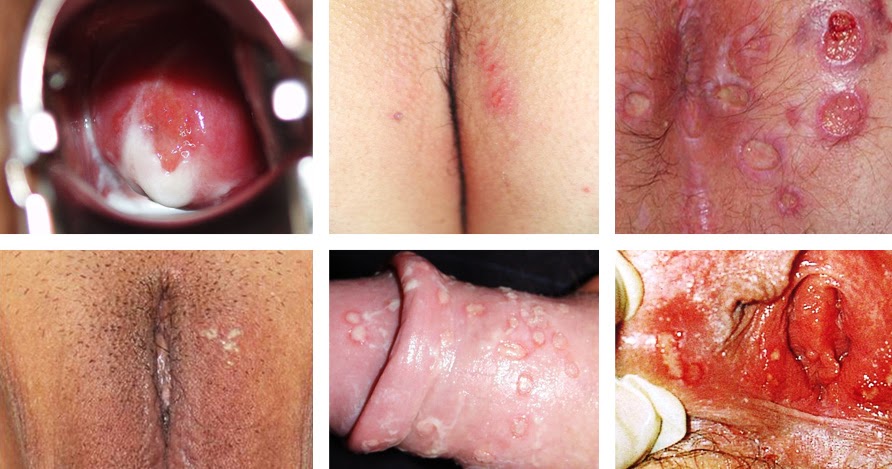 Harnwegsinfektion männer symptome