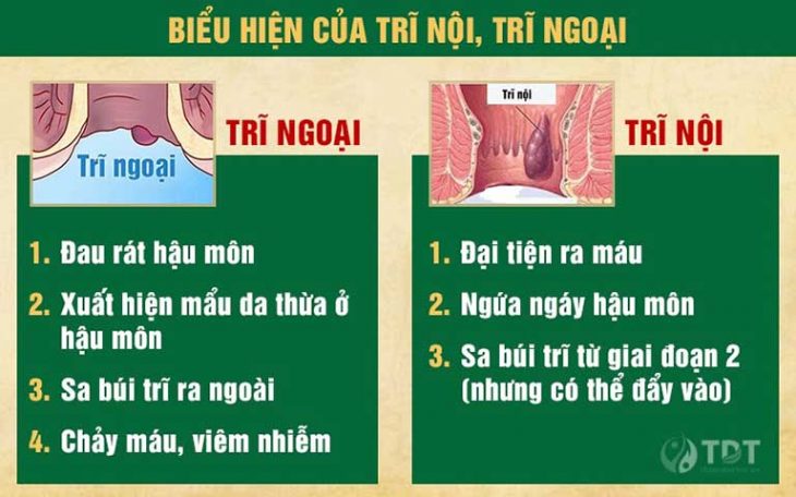 Dấu hiệu nhận biết trĩ nội, trĩ ngoại