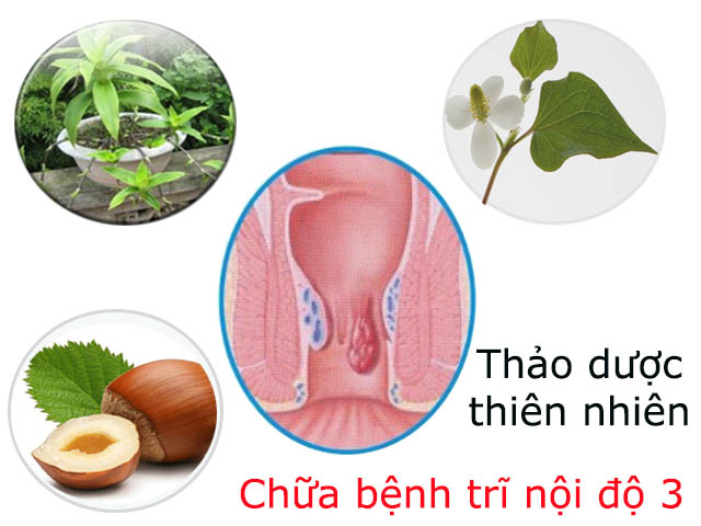 Cách chữa bệnh trĩ nội độ 3